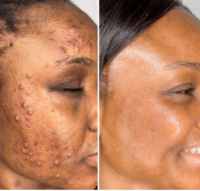 Savon anti - taches au curcuma | 100% Naturel (GN)