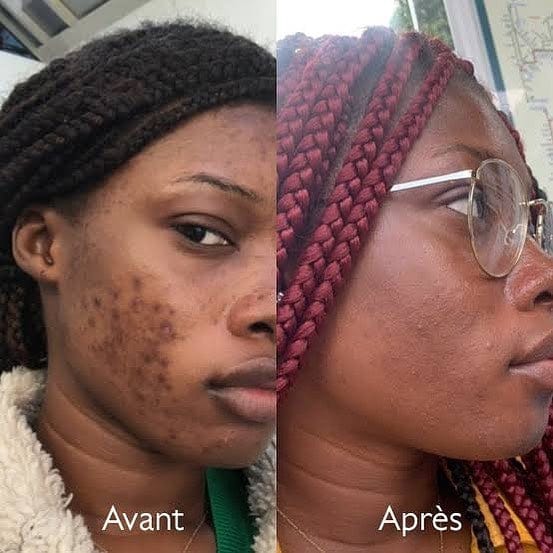 Savon anti - taches au curcuma | 100% Naturel (GN)