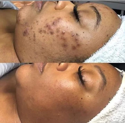 Sérum the ordinary(Niacinamide)