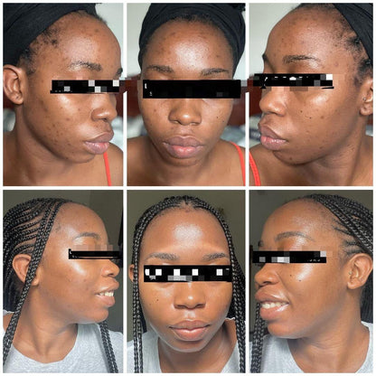 Savon anti - taches au curcuma | 100% Naturel (GN)