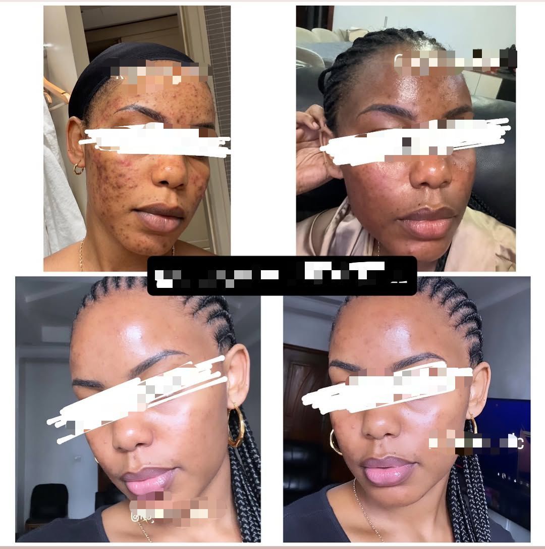 Savon anti - taches au curcuma | 100% Naturel (GN)